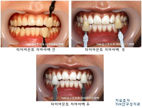 치아미백의 종류와 다이아몬드미백 - 뉴스와이어