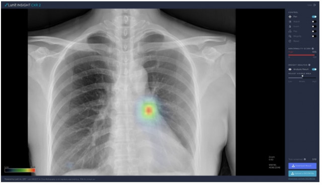 루닛의 폐 질환 진단 보조 AI 소프트웨어인 ‘루닛 인사이트 CXR’. 인공지능을 활용해 흉부 엑스레이의 비정상 소견을 표시한다