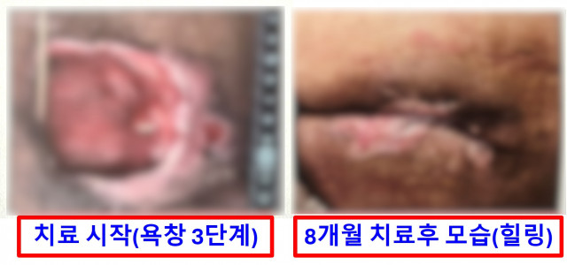 욕창-치료 전후 비교