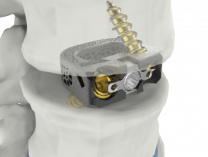 척추 융합기기 ‘유니스페이스(UniSpace® TPLIF Cage, 요추 케이지)’ 미국 FDA 승인 획득