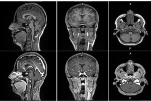 First-in-human contrast enhanced MRI images with GE HealthCare’s mangaciclanol