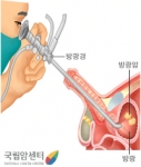 방광경 검사를 통해 방광암의 유무와 위치를 확인하는 모습(국립암센터 제공)