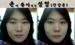 건강운이 좋아지는 성형의 예