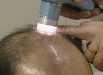 탈모치료