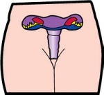 난소물혹의 증상과 치료