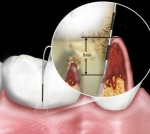 치주 질환을 치료하자!