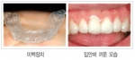 치아 미백에 관한 일문일답