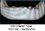 강남굿모닝치과, “ 정확한 임플란트 시술,  3차원 CT촬영 중요 ”