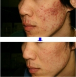 레이저로 여드름 치료를 받은 남학생의 사진!