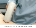 릴렐그F2리프팅 시술모습