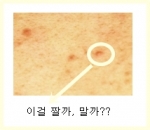 여드름은 함부로 짜면 흉이 지기 쉽고, 그대로 두면 블렉헤드가 되어 잡티가 되기도 한다.