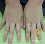 아토피·알레르기 체질의 공통적인 특징있어...근본원인을 치료해야