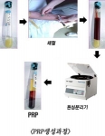 PRP(Platelet Rich Plasma)활용 범위 미용·성형분야 등 다양해져