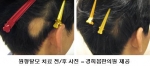 극심한 취업 스트레스 원형탈모로 이어져