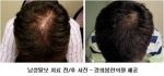 성공취업 위해 탈모치료 결심하는 남성 늘어