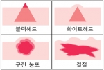 여드름의 종류-화접몽한의원 조사