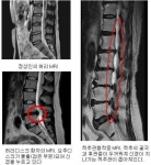 연령대로 알아보는 허리 질환