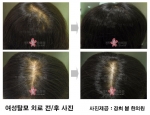 탈모치료, 이제 원인부터 치료하자