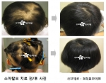 소아 ‘원형탈모증’ 증가