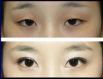 나에게 맞는 ‘쌍꺼풀 수술’은?