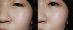 졸린 눈 상안검을 교정하는 눈매교정술