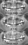 치주염을 앓고 있는 치아