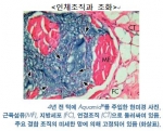 4년전 턱에 필러 아쿠아미드를 주입한 후 인체조직 변화 모습을 찍은 현미경 사진