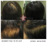 다이어트로 인한 여성탈모