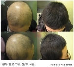 ‘난치성 원형탈모’의 치료와 극복법