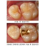 루덴치과, 기능과 심미 모두 만족시키는 충치치료 ‘테세라 인레이’ 시술