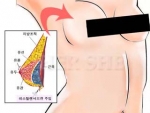 보형물 없이도 가슴 확대를 가능하게 하는 ‘레스틸렌 필러’