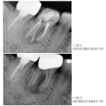 “치아살리려면 신경치료와 잇몸치료 모두 필요”