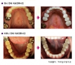 전체 보철법을 통해 깨끗한 치아로 변한 모습