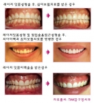 레이저 잇몸성형 및 잇몸미백술로 더욱 깨끗한 미소를 되찾는 방법을 보여주고 있다.