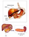 “어떤 암보다 조기진단이 중요한 췌장암의 증상”
