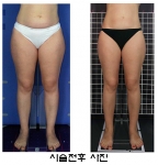 하체비만 극복에 도움이 되는 소닉스타 스키니 시술 전후