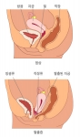 폐경 후 과체중인 50대 여성, ‘골반 장기 탈출증’ 주의해야