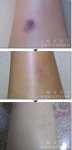 화상흉터 치료과정