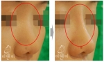 쁘띠성형 시술 전/후