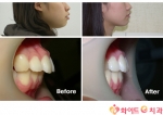 ‘돌출입교정’, 정확한 진단과 치료방법으로 치료 가능