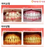 치아교정 VS 치아성형, 개인별 맞춤 치료 필요