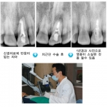 신경치료 불가능한 치아염증, 미세현미경 이용한 치근단 수술로 해결하자