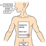 비염 축농증, 머리는 차게 손발은 따뜻하게
