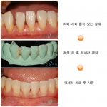 루덴치과, 테세라를 이용한 무삭제 치아성형 선보여