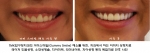 거미 스마일(Gummy Smile) 해소를 위한 이미지성형 전후사진