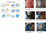 내시경 점막하 박리술