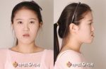 청은양의 주걱턱 수술 전