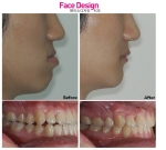 양악수술과 부정교합 치료의 성공요인