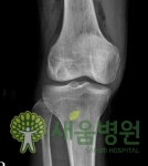 심각한 무릎 관절 손상은 ‘연골판 이식’으로 해결 가능
