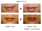 입술필러 시술 전후사진